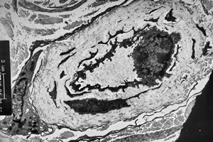 M, 48y. | multiplication of dermal perivascular basement membranes (unclassified myopathy) M, 48y. | multiplication of dermal perivascular basement membranes (unclassified myopathy)